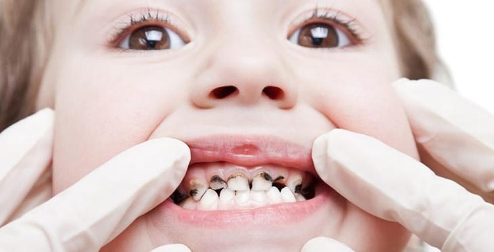 سیاه شدن دندان کودکان