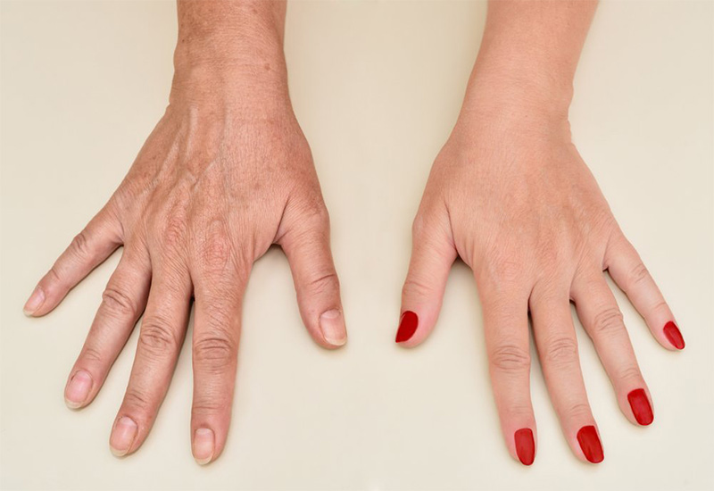 چروک شدن پوست دست